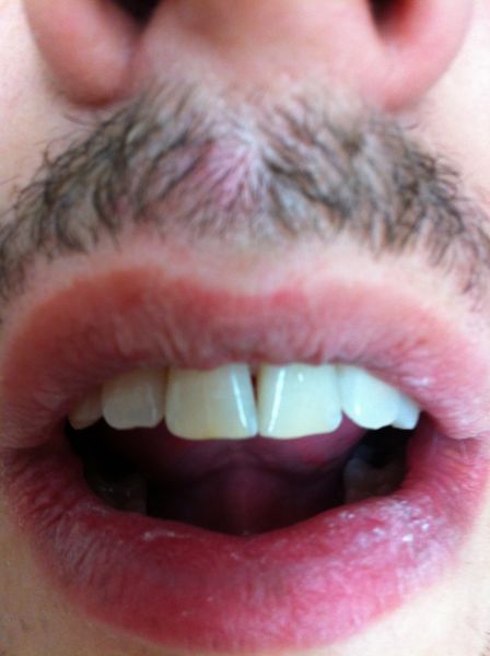 Petites retouches et grand résultats: les coronoplasties